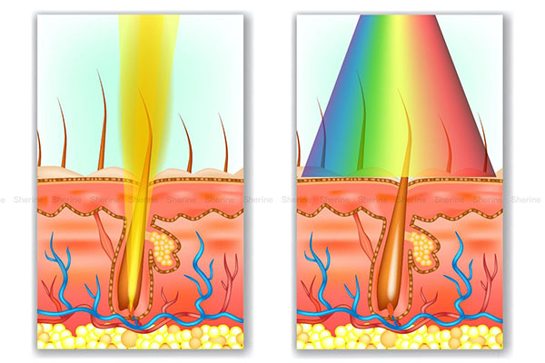 808nm-laser-hair-removal