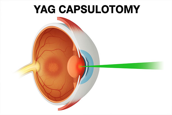 Nd-YAG-lasers