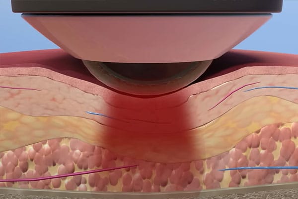 Laser therapy