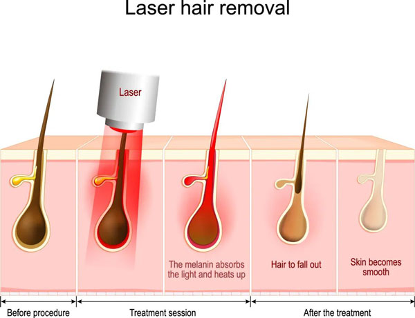 808nm diode-laser-hair-removal
