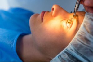 eye laser surgery