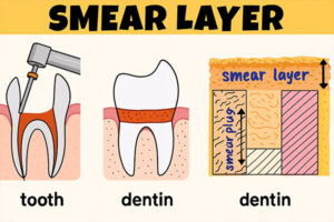smear-layer