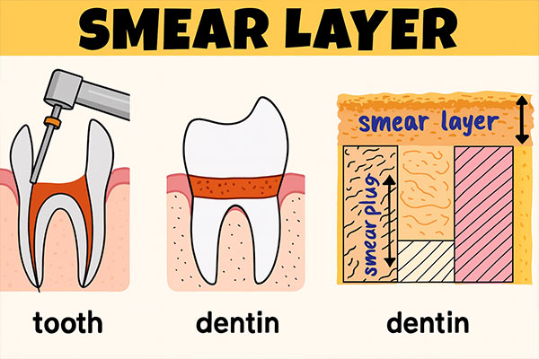 smear-layer