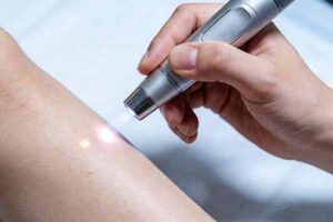 Beauty-Laser-Equipment