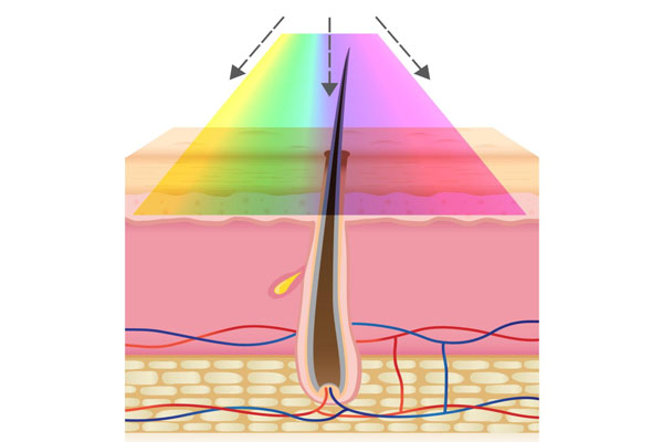 IPL hair removal