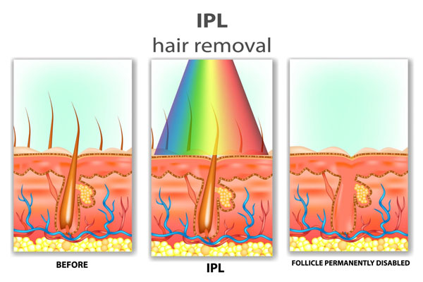 IPL hair removal effect