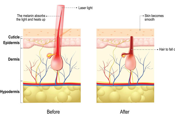 laser hair removal effect